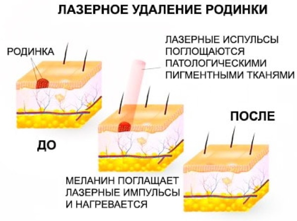 Удаление родинок на лице радиоволновое, азотом, Сургитроном. Цена