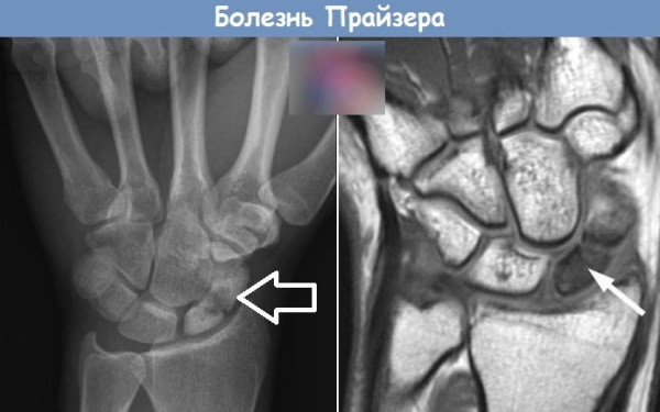 Запястье руки. Анатомия, где находится, как болит, причины, лечение