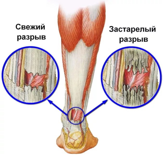 Ахиллово (ахиллесово) сухожилие. Где находится на ноге, фото, анатомия