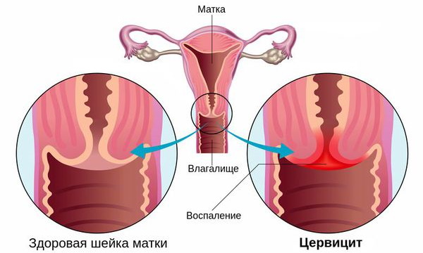 Аналоги Канефрона в таблетках при беременности, лактации. Цена