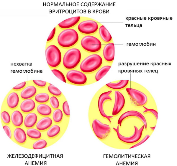 Анемия. Классификация по гемоглобину ВОЗ у мужчин, детей, женщин