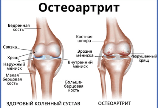 Болит поясница сильно, ноет. Причины и лечение у женщин