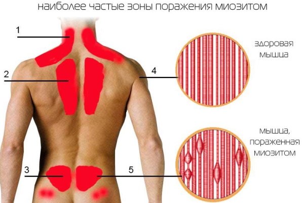 Болит поясница сильно, ноет. Причины и лечение у женщин