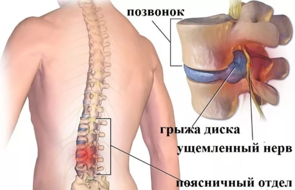 Болит поясница сильно, ноет. Причины и лечение у женщин