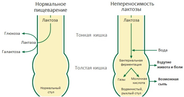 Бурчание в животе. Причины и лечение после еды, при панкреатите, гастрите, аппендиците