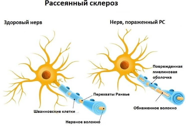 Миорелаксанты для снятия мышечных спазмов препараты. Список