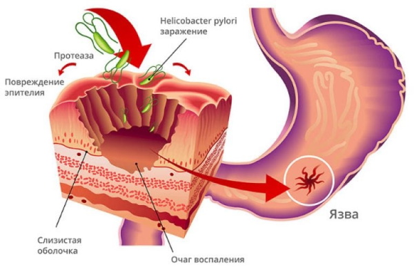 Хеликобактериоз. Симптомы и лечение взрослых, детей