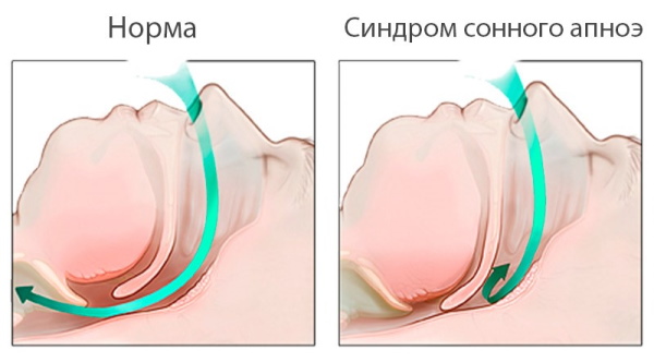 ИМТ (Индекс массы тела). Как рассчитать, формула, оценка результатов