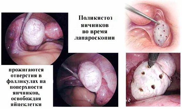 Лапароскопия в гинекологии. Что это такое, операция