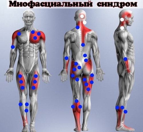 Миофасциальный синдром. Что это такое, как лечить диагноз, причины