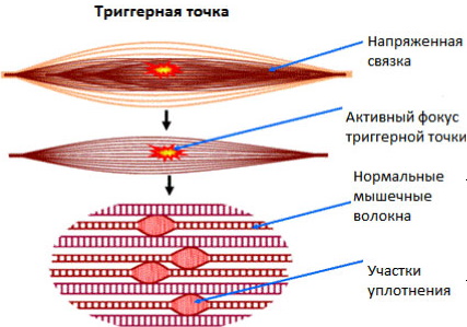 Миофасциальный синдром. Что это такое, как лечить диагноз, причины