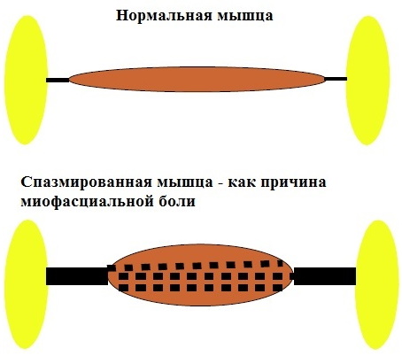 Миофасциальный синдром. Что это такое, как лечить диагноз, причины