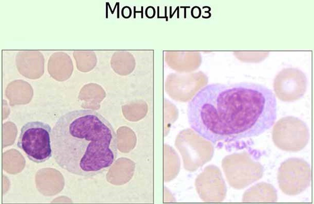Моноцитоз в крови. Что это такое, причины, лечение у взрослых