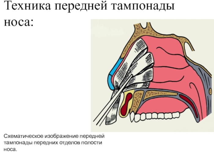 Передняя тампонада носа. Алгоритм действий, показания, как выполняется