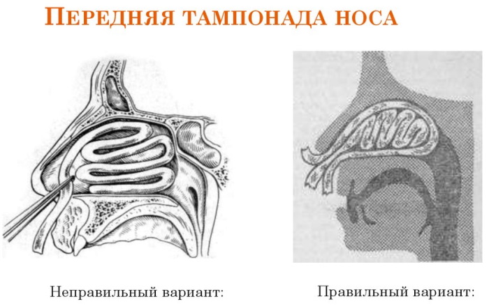 Передняя тампонада при носовом кровотечении