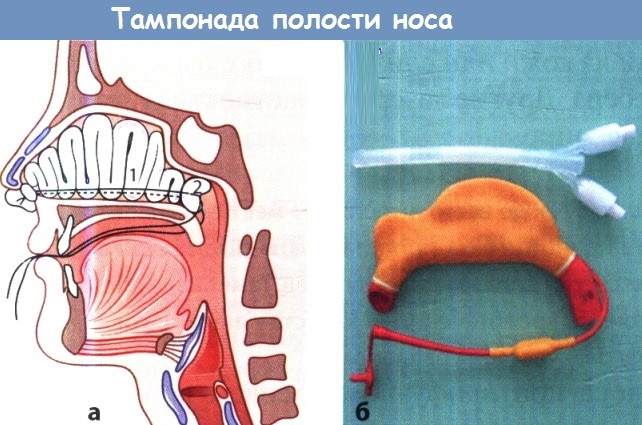 Передняя тампонада носа. Алгоритм действий, показания, как выполняется