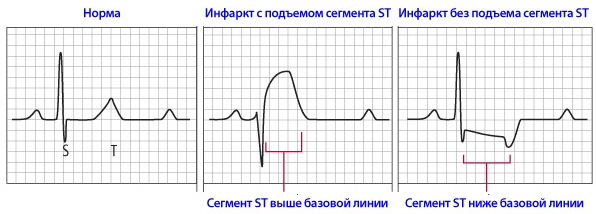 Как прочитать электрокардиограмму сердца самому. Расшифровка ЭКГ