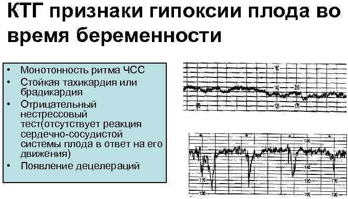 Признаки гипоксии плода в третьем, втором триместре, на КТГ