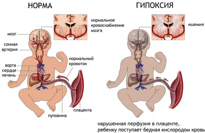 Признаки гипоксии плода в третьем, втором триместре, на КТГ