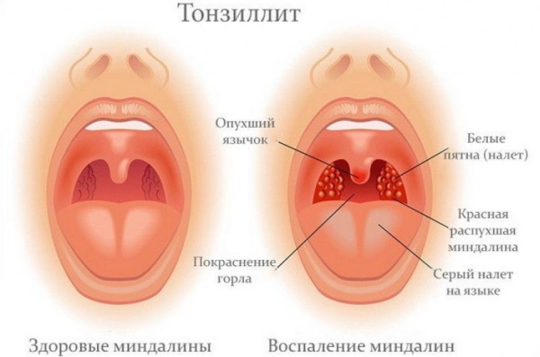 Риноцитограмма у детей. Расшифровка, норма в таблице