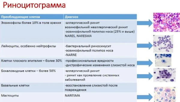 Риноцитограмма у детей. Расшифровка, норма в таблице