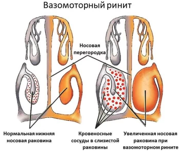 Риноцитограмма у детей. Расшифровка, норма в таблице