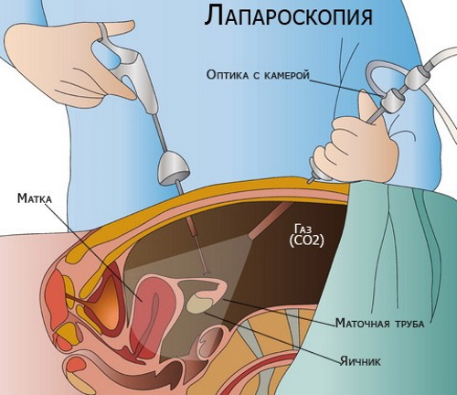 Сальпингоофорит. Симптомы и лечение у женщин. Препараты, народные средства