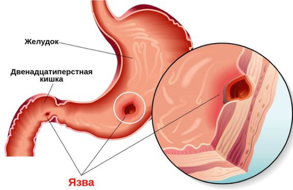 Дипроспан аналоги и заменители в ампулах