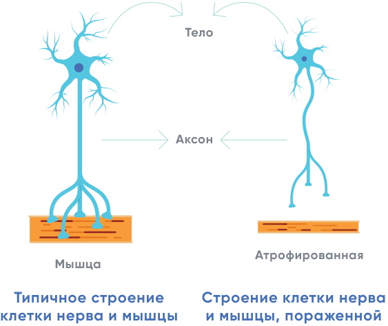 Спинальная мышечная атрофия презентация