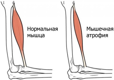 Последствия клещевого энцефалита головного мозга