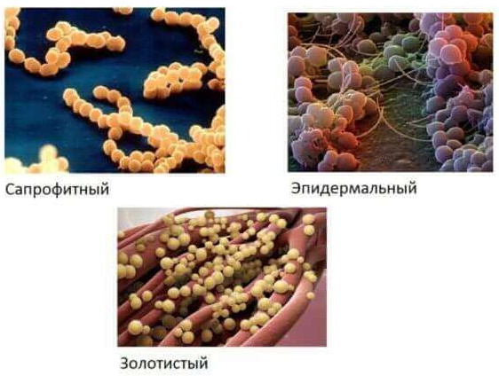 Стафилококк эпидермальный в мазке у женщин. Норма, лечение