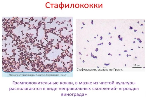 Стафилококк эпидермальный в мазке у женщин. Норма, лечение