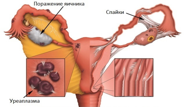 Уреплазменная инфекция у женщин. Лечение препаратами, народными средствами