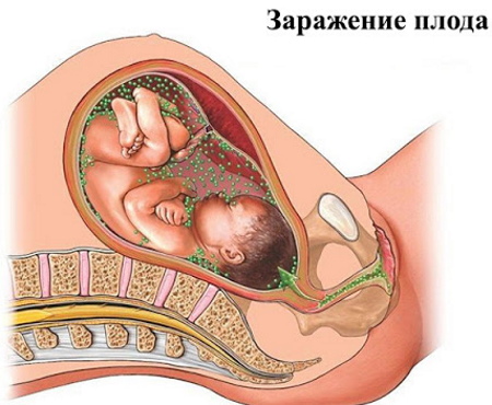 Уреплазменная инфекция у женщин. Лечение препаратами, народными средствами