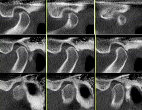Височно-нижнечелюстной сустав. Анатомия, строение, функции, лечение