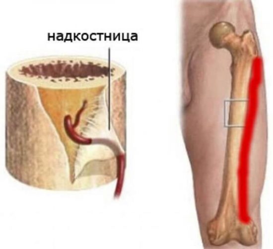 Воспаление надкостницы голени при беге. Лечение