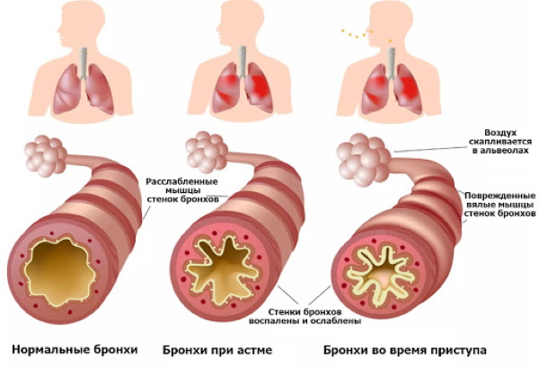 Вред вейпа для здоровья с и без никотина