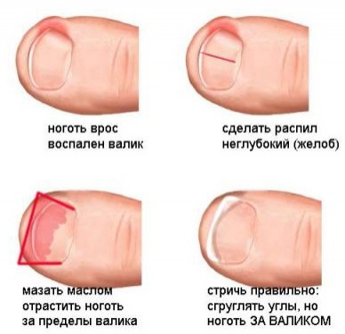 Вросший ноготь. Лечение лазером, пластинами, без операции йодом. Отзывы