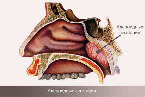 Лицо ребенка с аденоидами фото