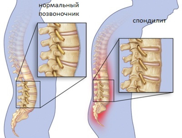 Аркоксиа и аналоги дешевле. Список, цены, отзывы