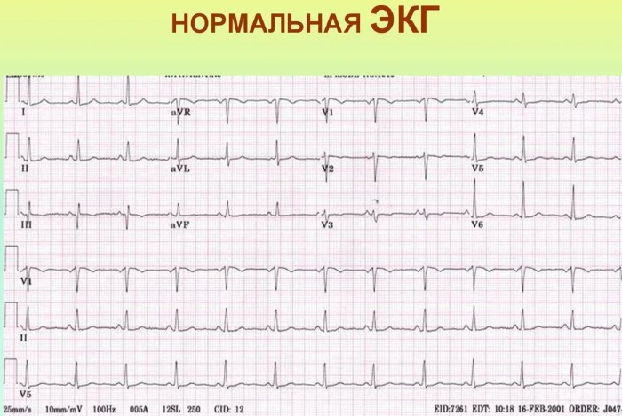 Боли в области сердца в состоянии покоя. Что это