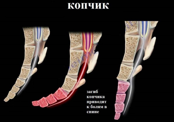 Болит копчик при беременности в 1-2-3 триместре. Причины, что делать