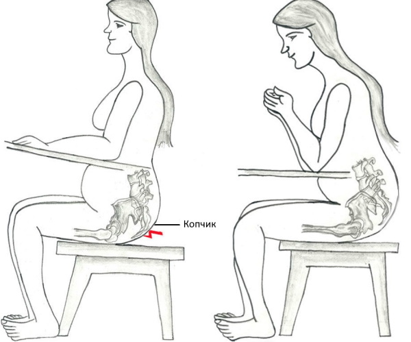 Болит копчик при беременности в 1-2-3 триместре. Причины, что делать