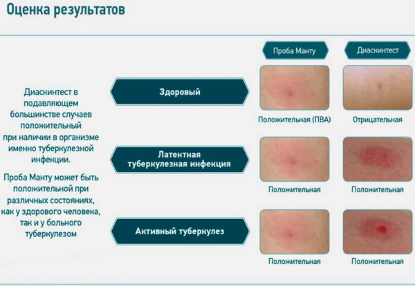 Диаскинтест оценка результатов фото