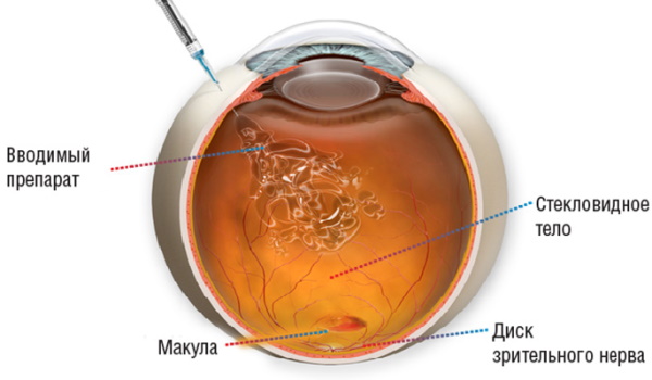 Эйлеа (Eylea) афлиберцепт укол в глаз. Отзывы, цена
