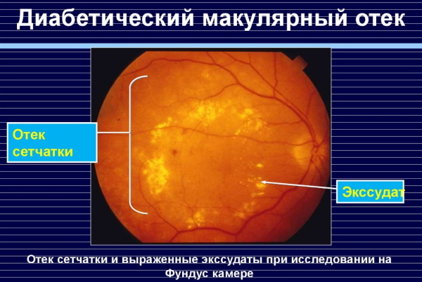 Эйлеа (Eylea) афлиберцепт укол в глаз. Отзывы, цена