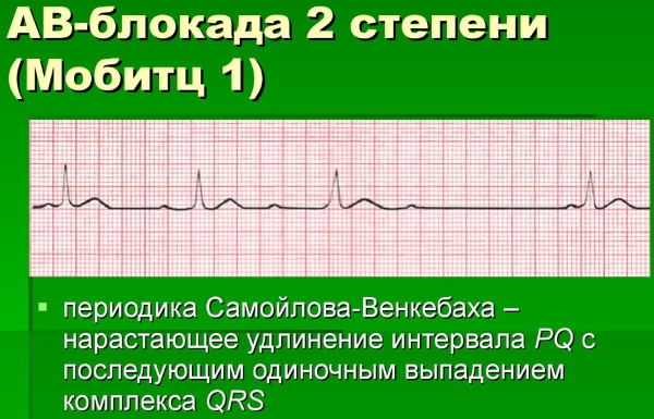 Интервал PQ на ЭКГ. Норма у детей, взрослых, какой процесс отражает, чему соответствует