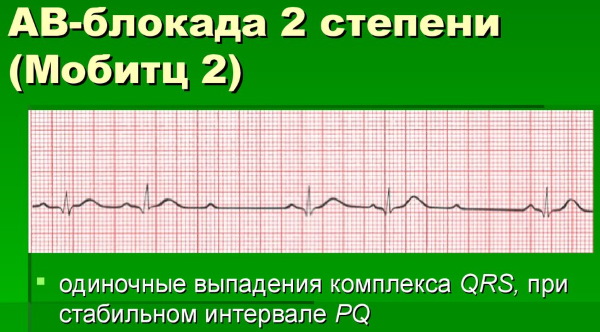 Интервал PQ на ЭКГ. Норма у детей, взрослых, какой процесс отражает, чему соответствует