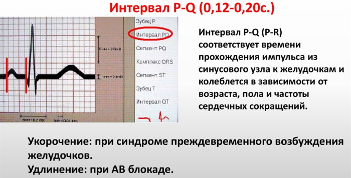 Интервал PQ на ЭКГ. Норма у детей, взрослых, какой процесс отражает, чему соответствует