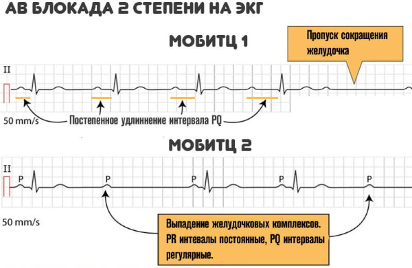Интервал PQ на ЭКГ. Норма у детей, взрослых, какой процесс отражает, чему соответствует